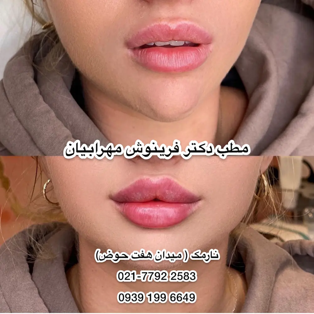 نمونه تزریق فیلر لب