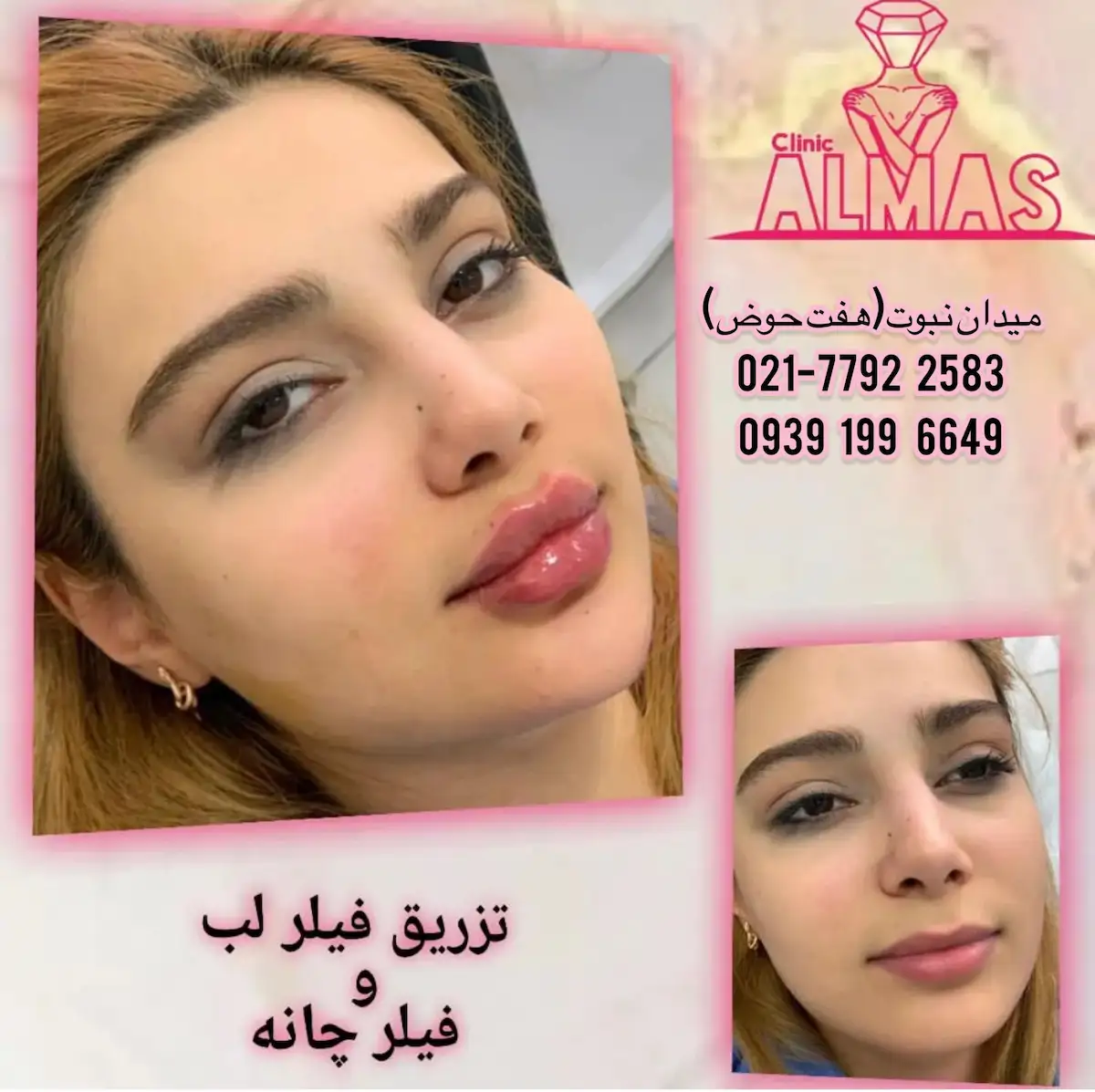 نمونه تزریق ژل توسط دکتر مهرابیان