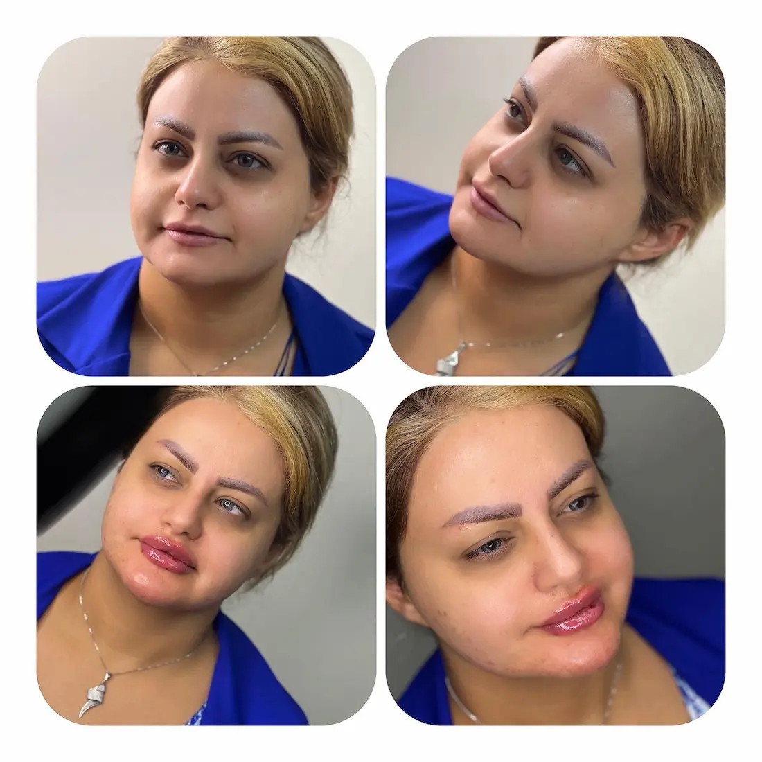 نمونه تزریق ژل لب