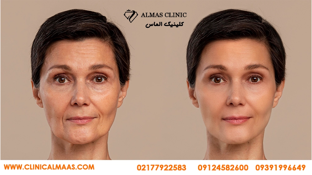 سن مناسب بوتاکس