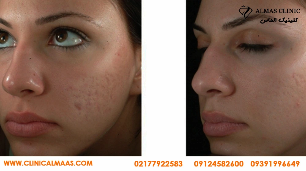 عکس قبل و بعد از میکرودرم ابریژن صورت