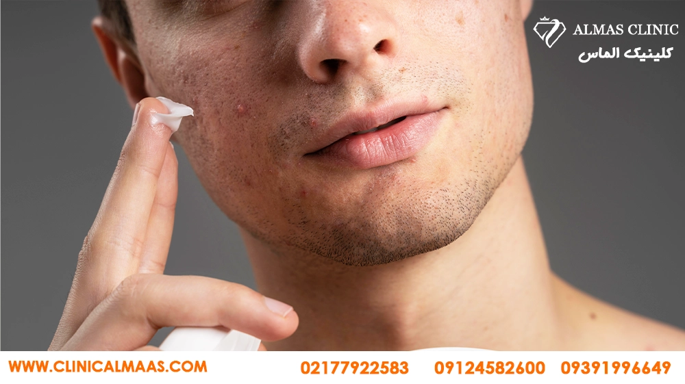 درمان جای جوش و اسکار