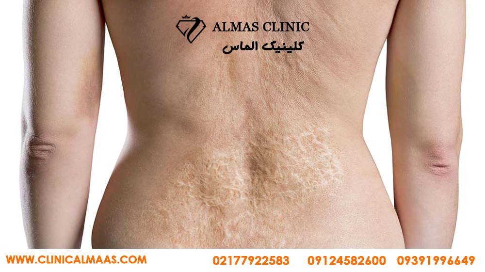 لیزر موهای زائد برای چه کسانی ضرر دارد؟