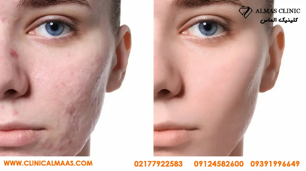 عکس قبل و بعد مزوتراپی صورت