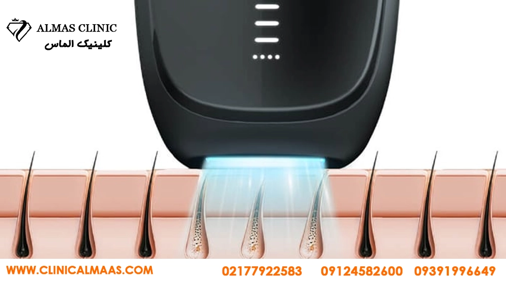 لیزر موهای زائد برای چه کسانی ضرر دارد؟