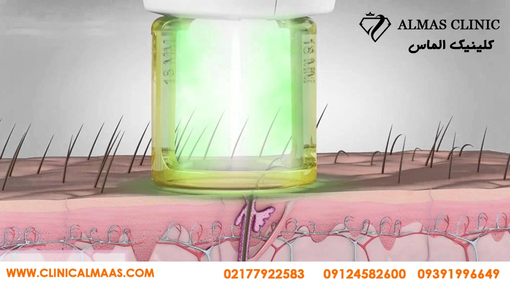 لیزر موهای زائد برای چه کسانی ضرر دارد؟