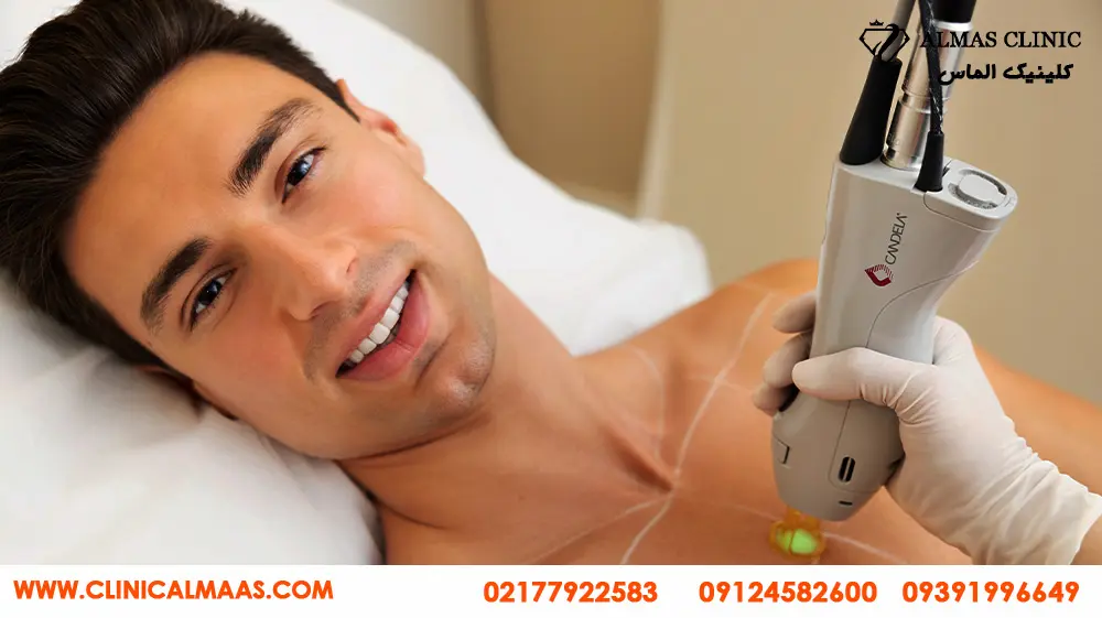 لیزر موهای زائد آقایان با کندلا