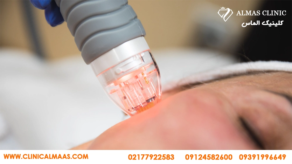 مزونیدلینگ (Mesoneedling)