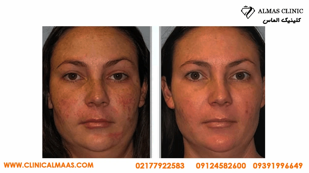 نمونه کار میکرودرم ابریژن برای رفع آکنه