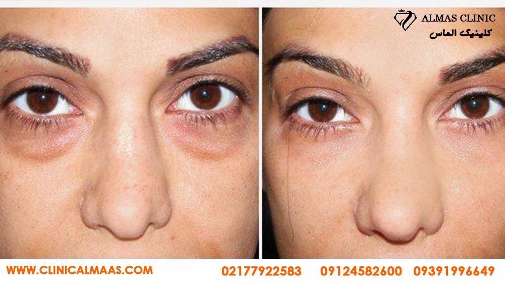 نمونه کار کربوکسی تراپی صورت