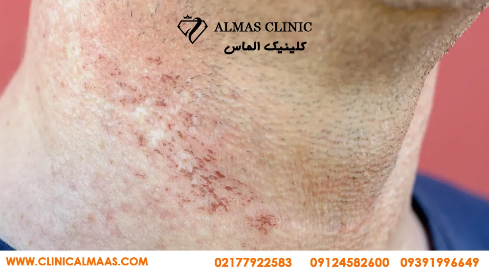 لیزر موهای زائد برای چه کسانی ضرر دارد؟