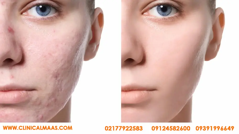 کلینیک تخصصی مزوتراپی مو در شرق تهران