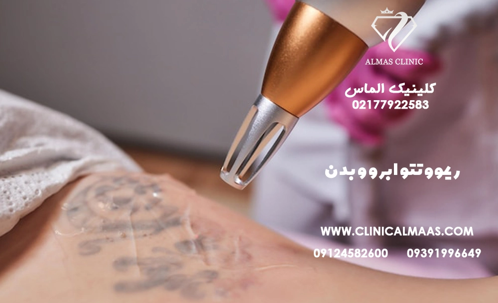 ریموو تتو ابرو و بدن | راهنمای کامل پاک کردن تاتو با لیزر