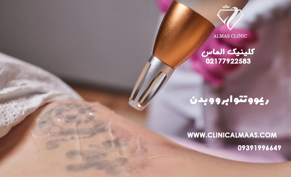 ریموو تتو ابرو و بدن | راهنمای کامل پاک کردن تاتو با لیزر