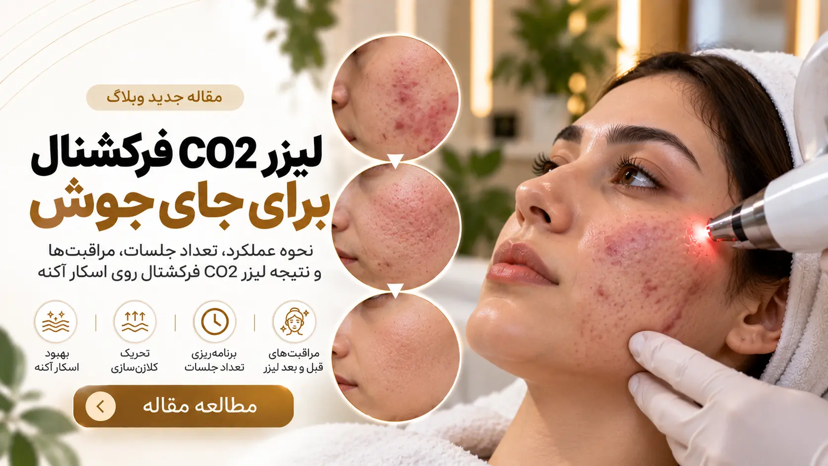 لیزر CO2 فرکشنال برای جای جوش؛ تأثیر آن روی اسکار و ناهمواری پوست