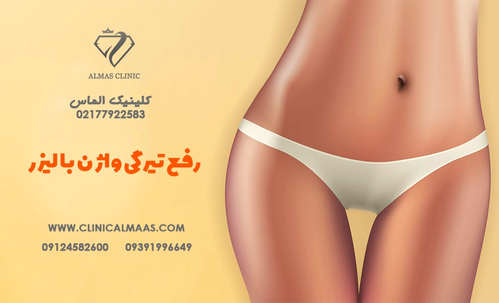 رفع تیرگی واژن با لیزر